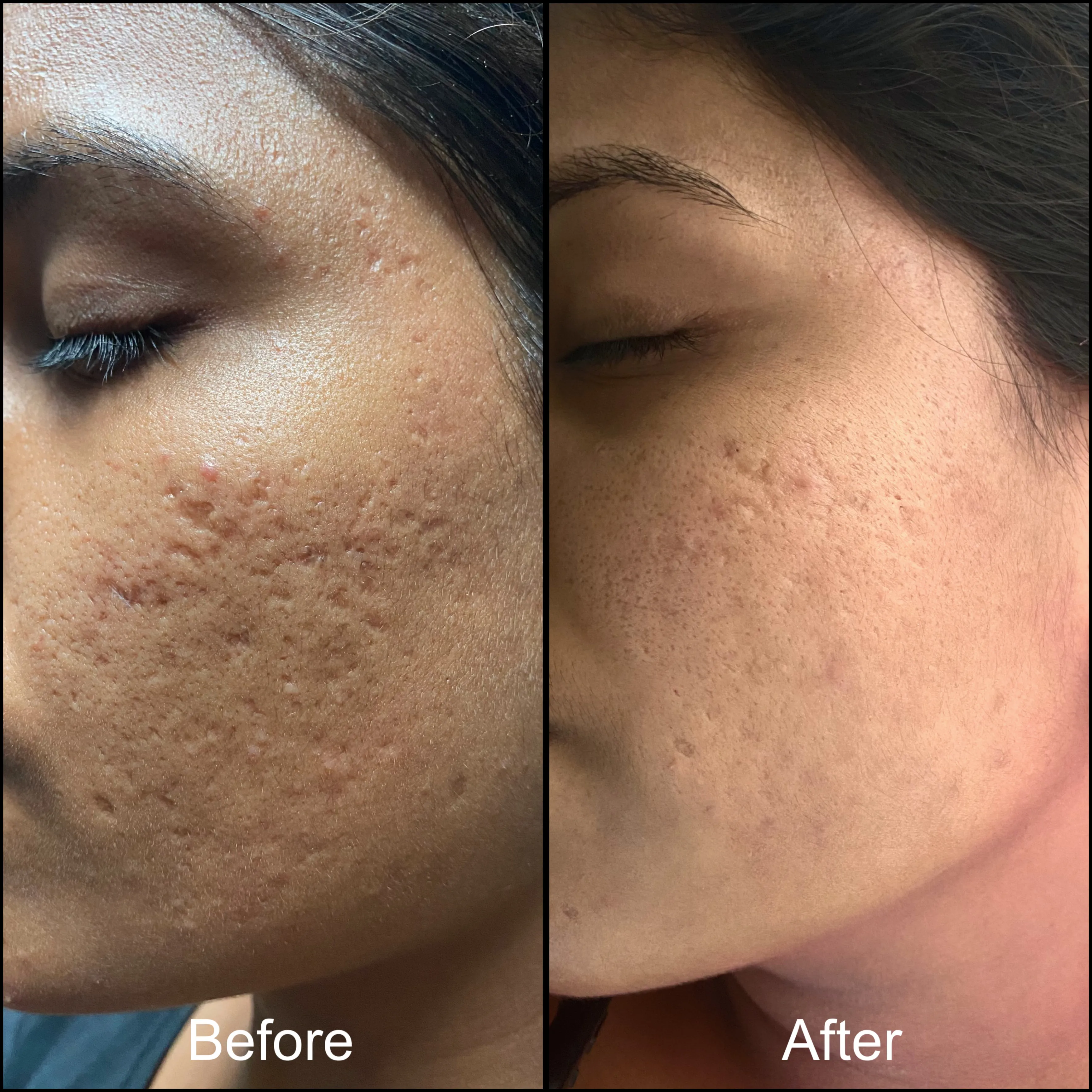 Acne Scar Treatment Results