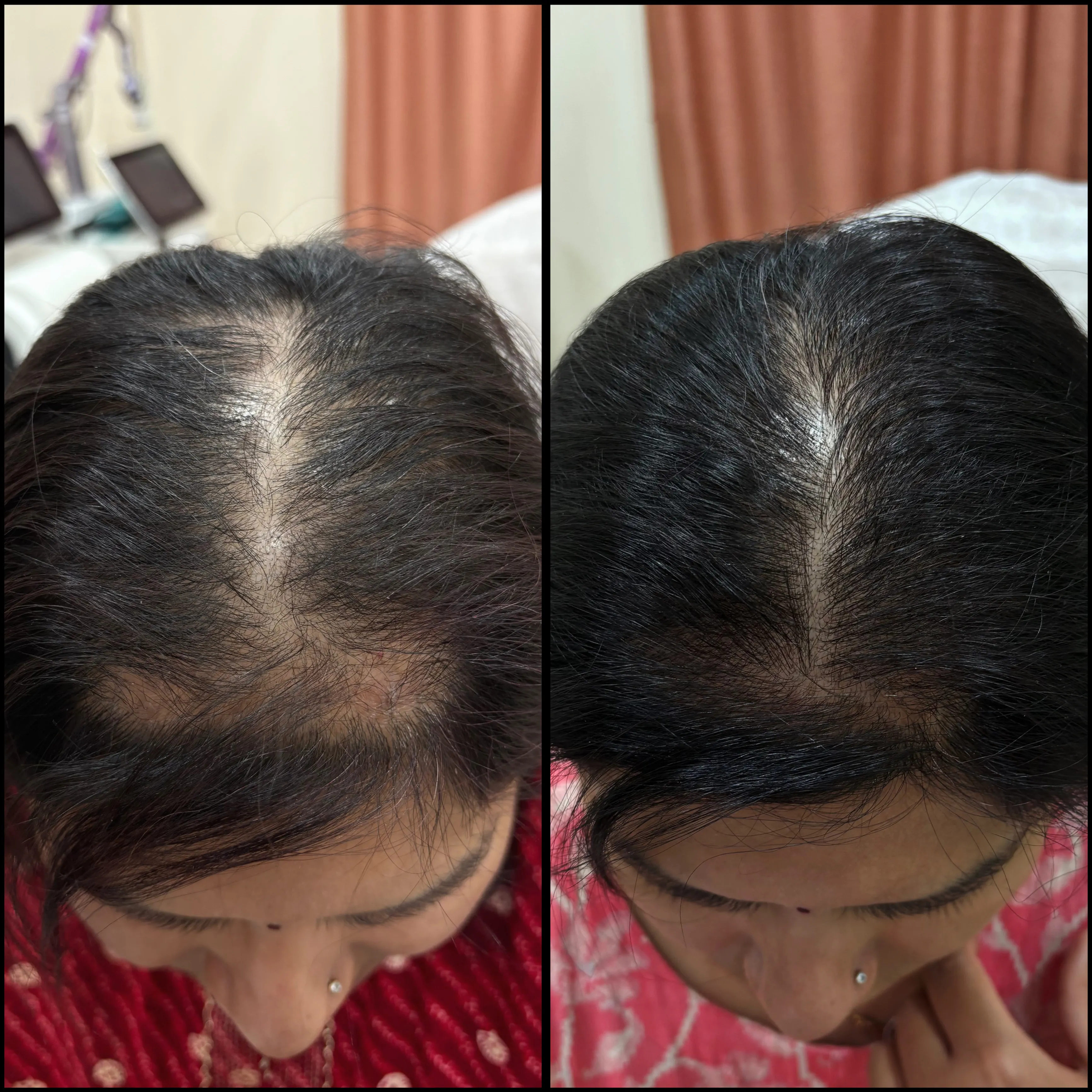 Hair Loss Treatment Results