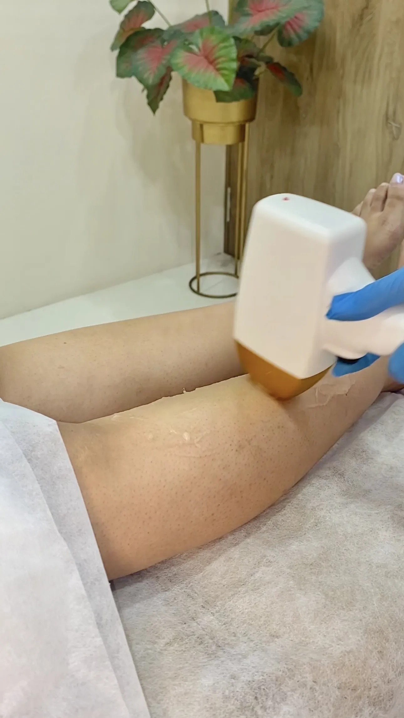 Laser Hair Removal