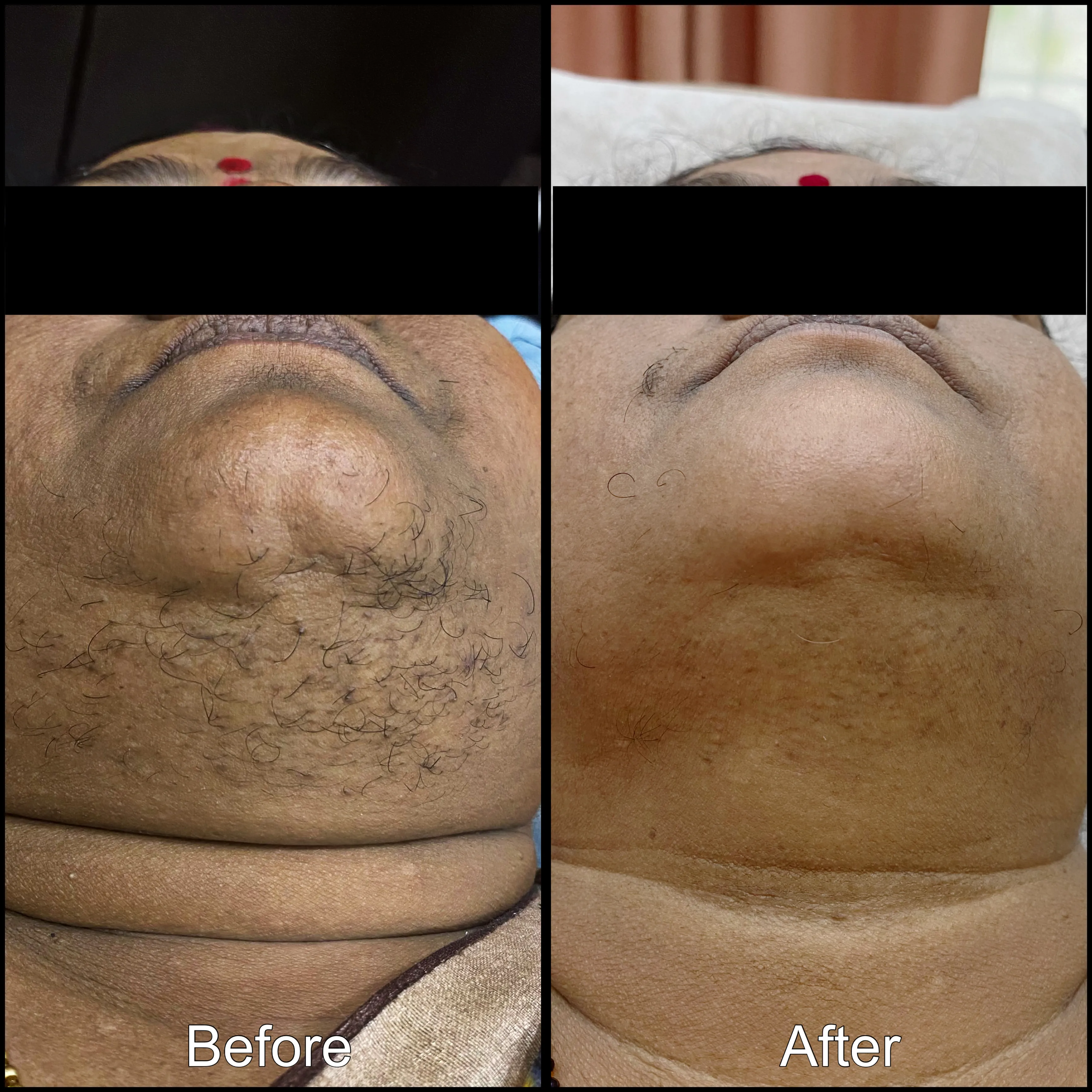 Laser Hair Removal at Dermys Clinic