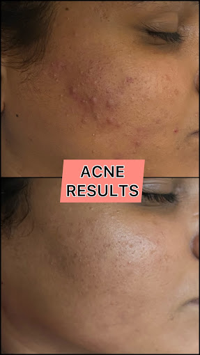Girl's face before and after acne treatment at Dermys clinic Nagpur