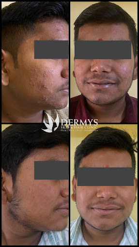 Boy's face before and after acne treatment at Dermys clinic Nagpur