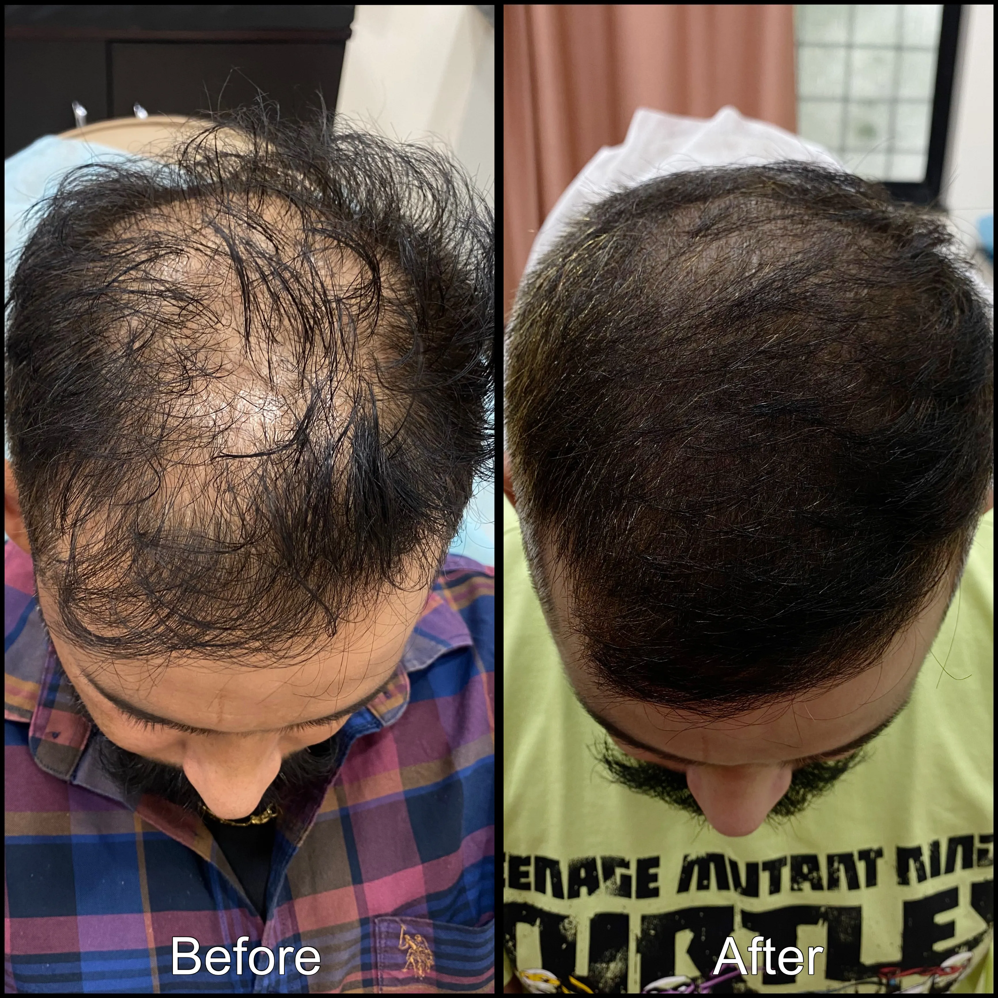 Male Pattern Balding Treatment