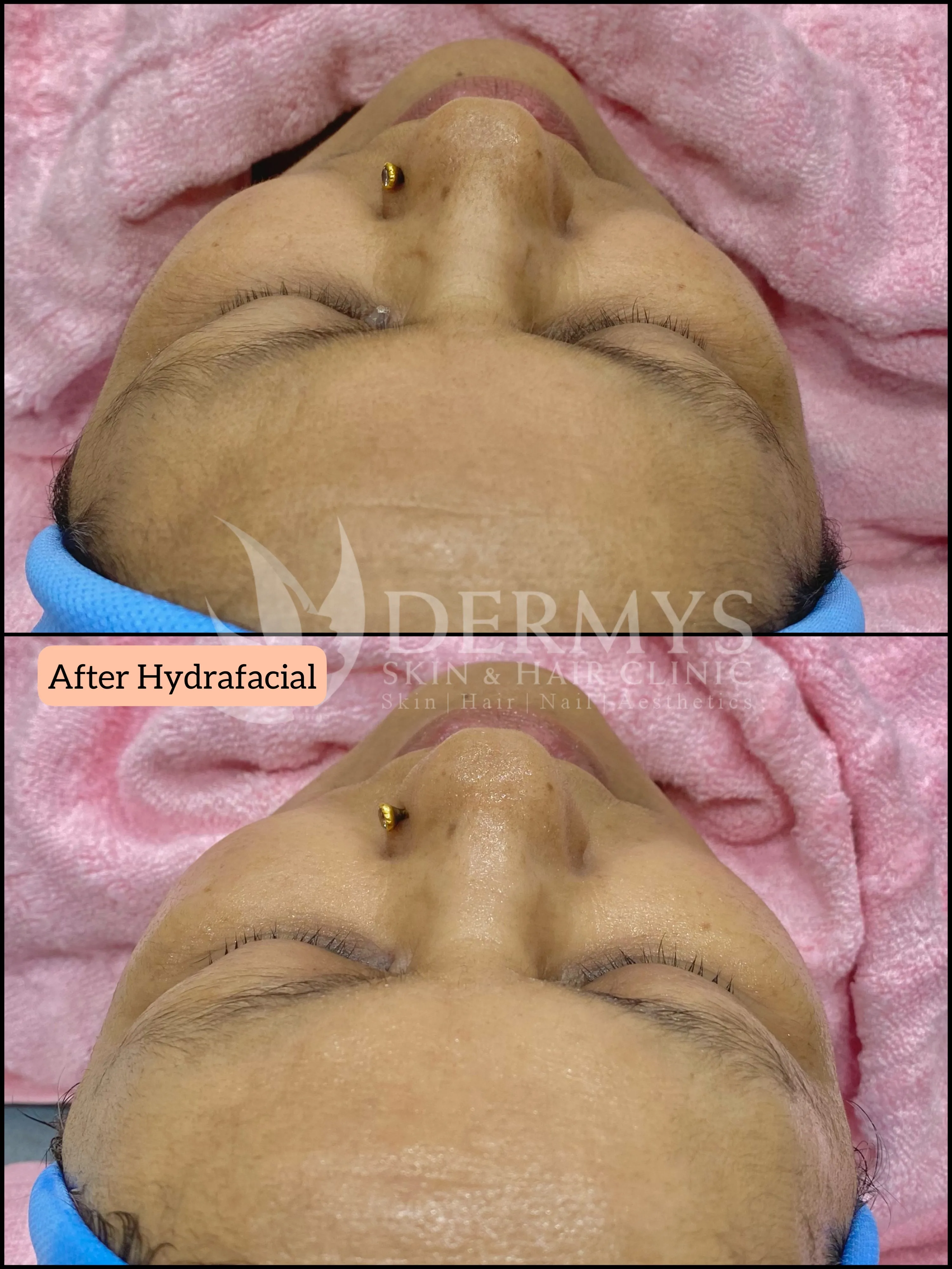 Hydrafacial treatment at Dermys clinic Nagpur