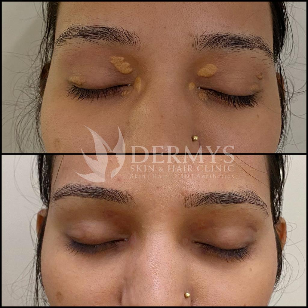 Girl's face before and after Xanthelasma removal at Dermys clinic Nagpur