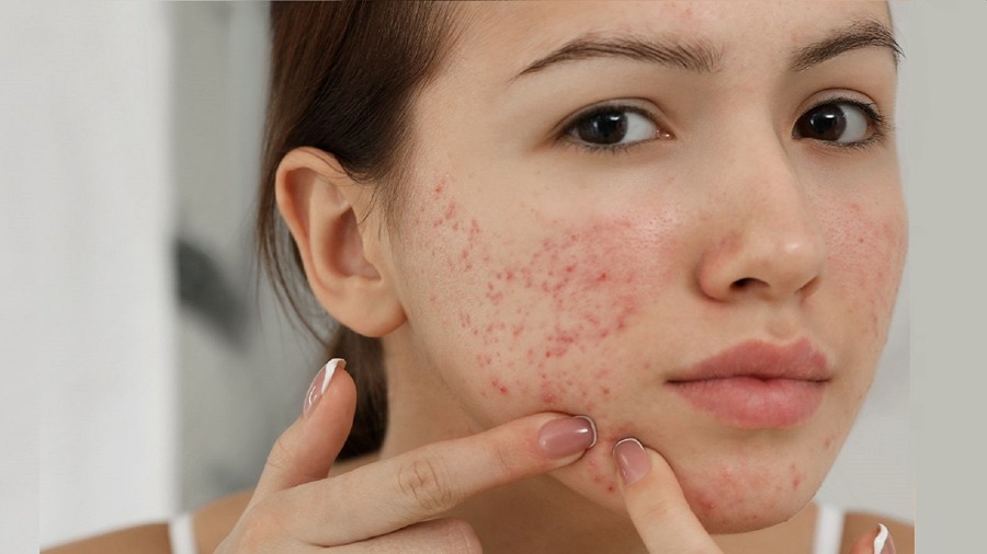 treatment of acne at Dermys Clinic Nagpur