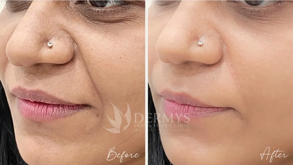 Anti-aging treatments available Dermys Clinic Nagpur