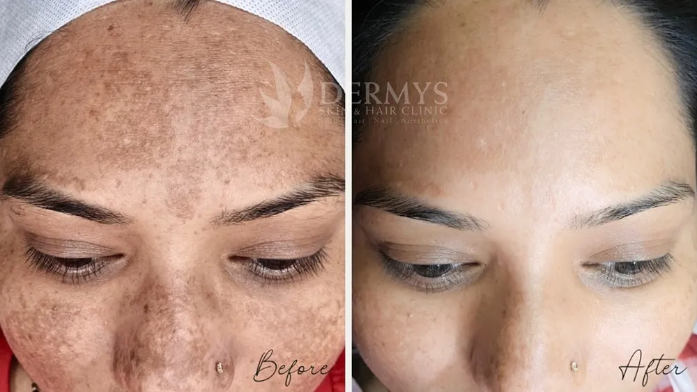 treatments for pigmentation available at Dermys Clinic Nagpur