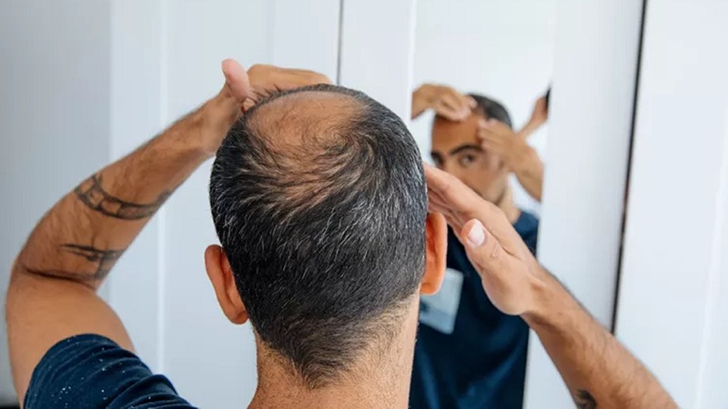 Treatments for Hair loss available at Dermys Clinic Nagpur
