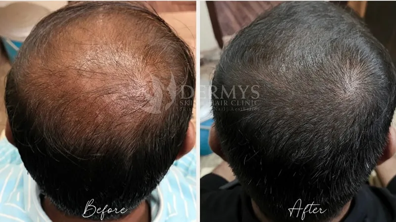 Treatments for Hair loss available at Dermys Clinic Nagpur