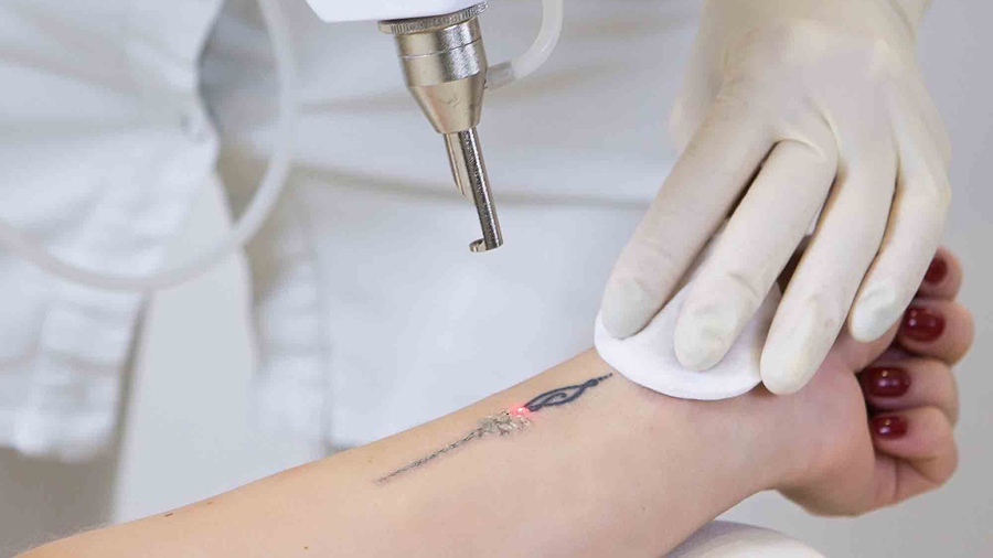 Tattoo removal being done at Dermys Clinic Nagpur