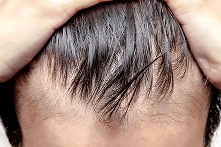 Guy with bald head showing hair loss on scalp