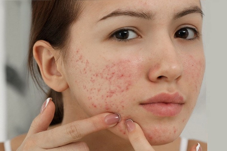 Girl with severe acne on right cheek
