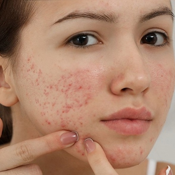 girl with severe acne on right cheek