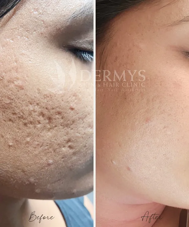 Acne scar revision being done at Dermys Clinic Nagpur