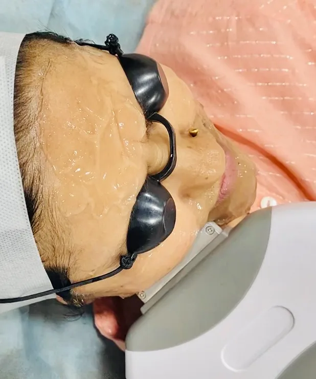 Photofacials being done at Dermys Clinic Nagpur