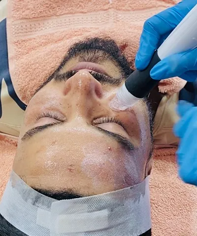 Hydrafacial at Dermys Clinic Nagpur